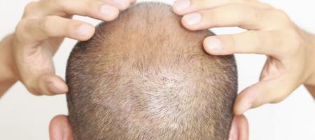 coiffure pour perte de cheveux