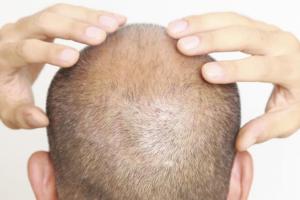 coiffure pour perte de cheveux